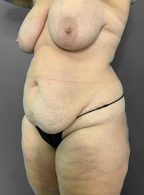Before and after body contouring results at Lentz Plastic Surgery.