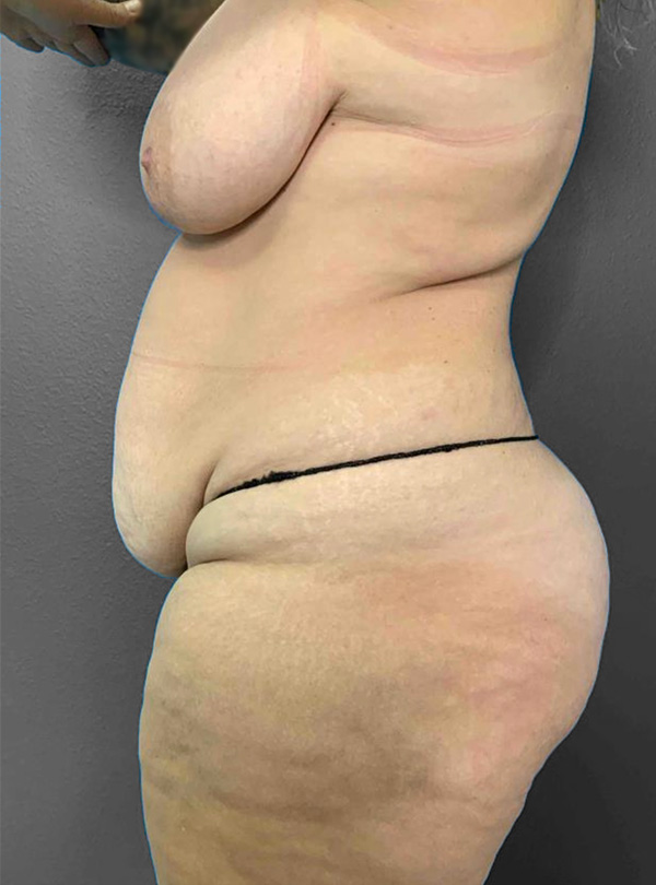 Before and after body contouring transformation at Lentz Plastic Surgery.