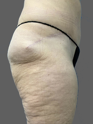 Before and after thigh contouring results at Lentz Plastic Surgery.