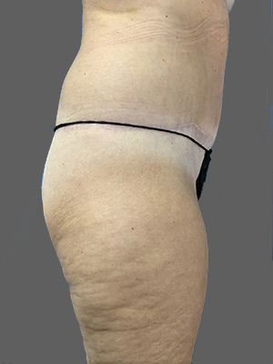 Side view of patient showcasing skin texture and body contouring results.
