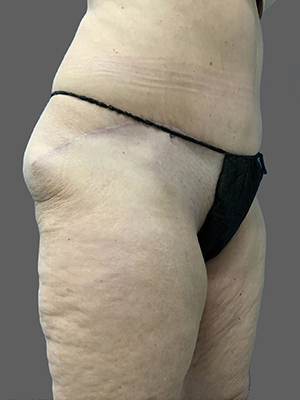 Patient's side profile highlighting skin texture and contours post-surgery.