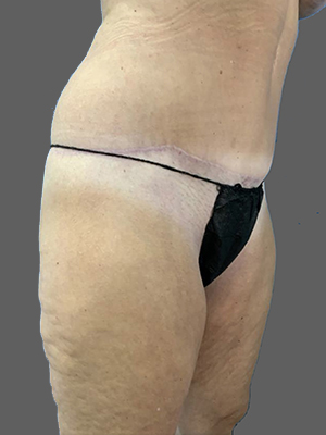Before and after body contouring results showcasing skin texture improvement.