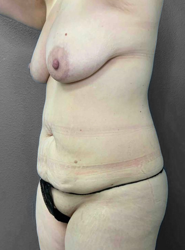 Realistic body model highlighting surgical results at Lentz Plastic Surgery.