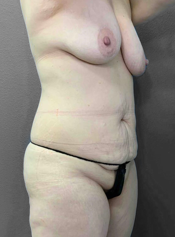 Before and after body contouring results showcasing patient transformation.
