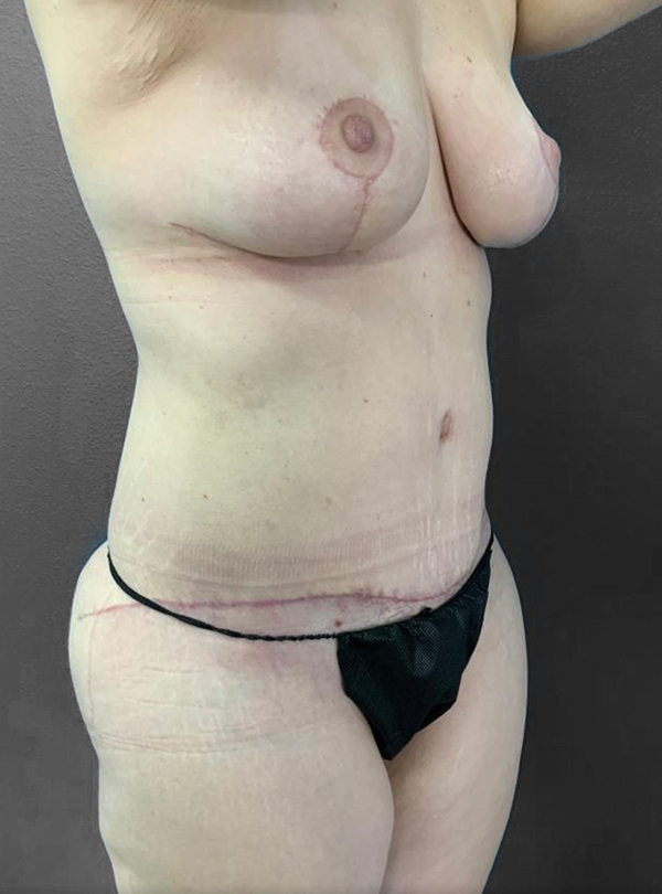 Post-surgery body contouring results showcasing natural healing and aesthetic improvement.