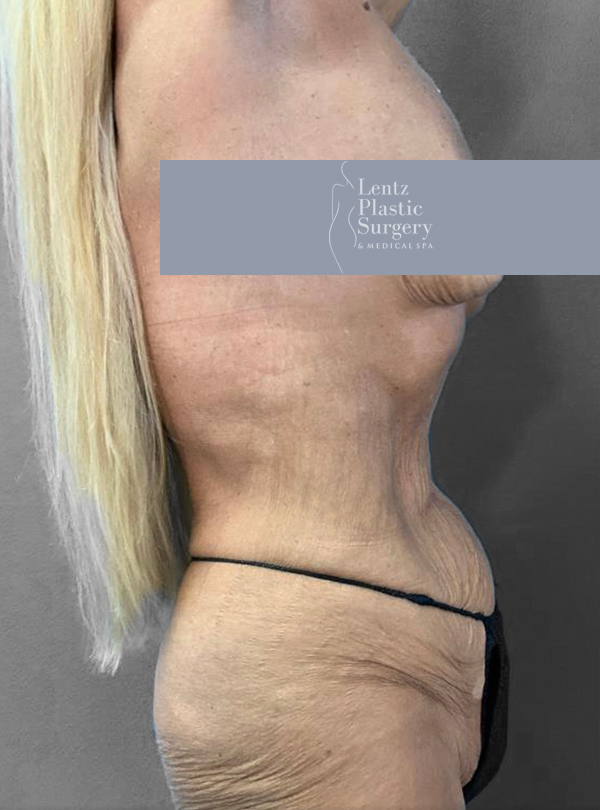 Side profile of a patient post-surgery showcasing body contouring results.