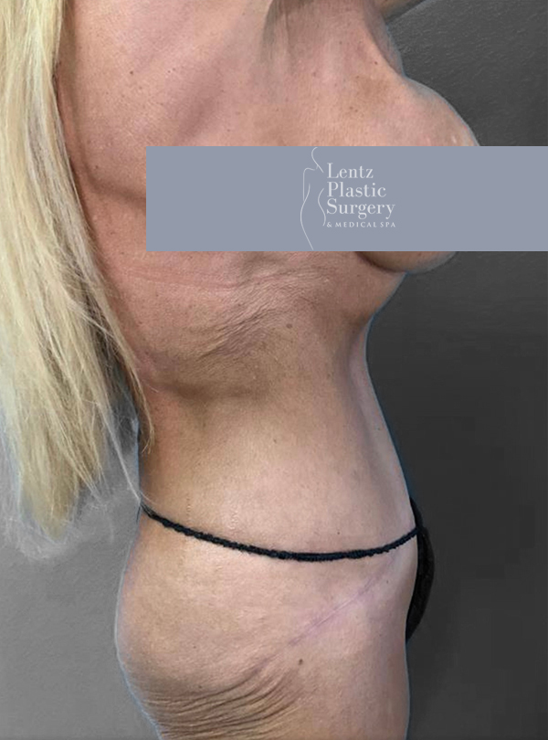 Profile view of a woman showcasing post-surgery results at Lentz Plastic Surgery.
