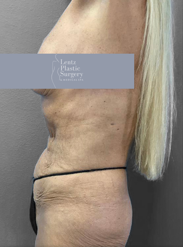 Profile view of a patient post-surgery at Lentz Plastic Surgery.