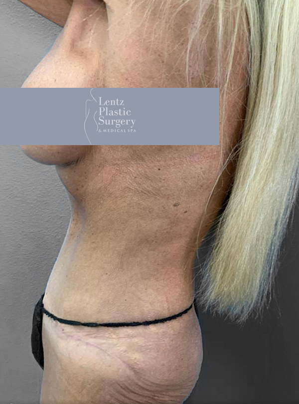 Profile view of a woman showcasing post-surgery results at Lentz Plastic Surgery.