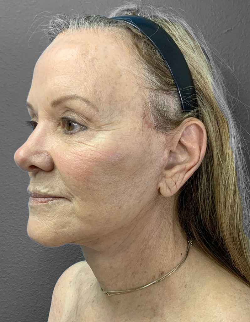 Profile view of a woman showcasing natural results from Lentz Plastic Surgery.