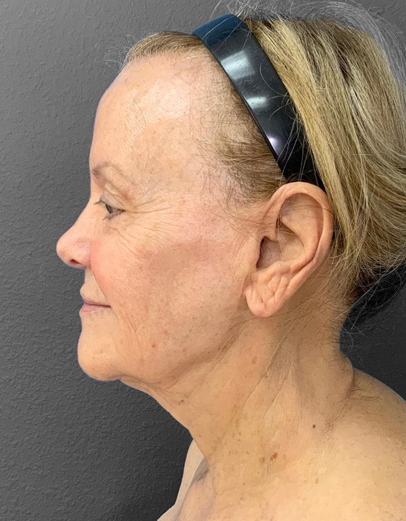 Profile view of a woman showcasing natural skin texture post-surgery.