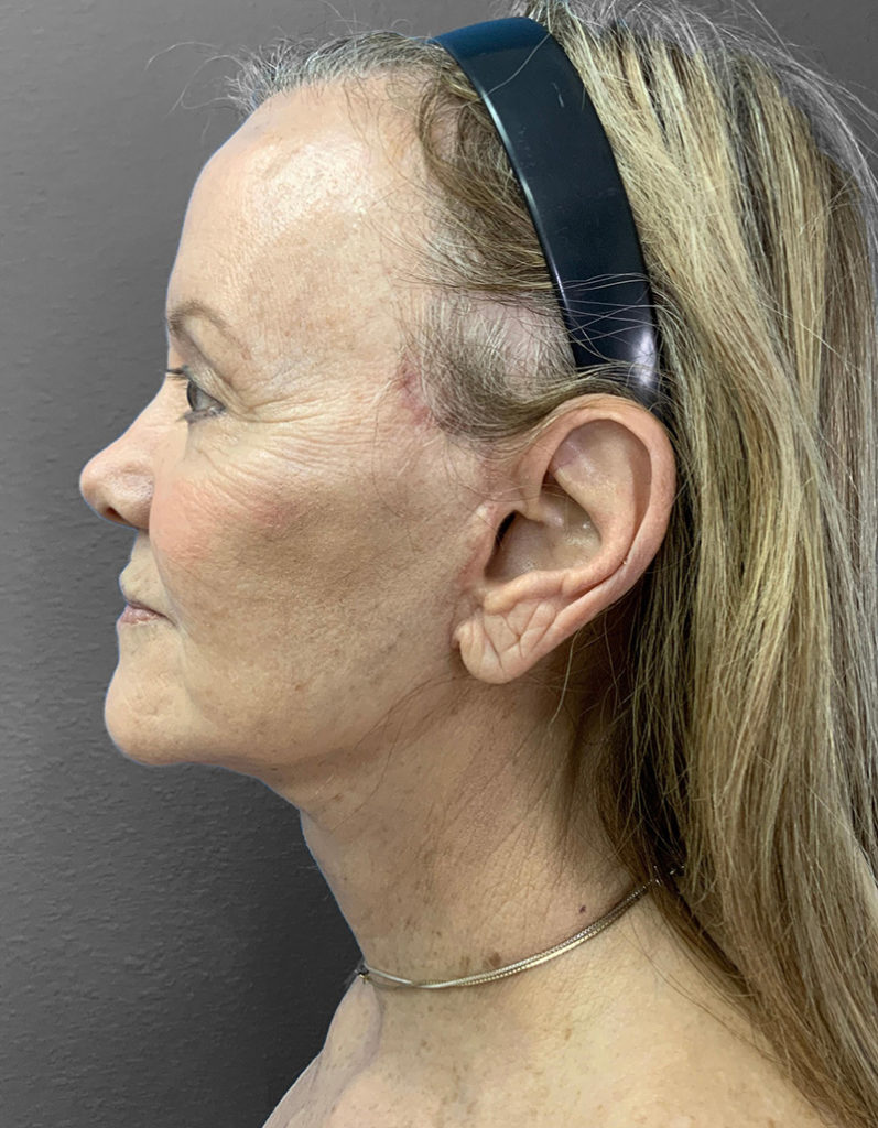 Profile view of a woman post-surgery, showcasing natural results at Lentz Plastic Surgery.