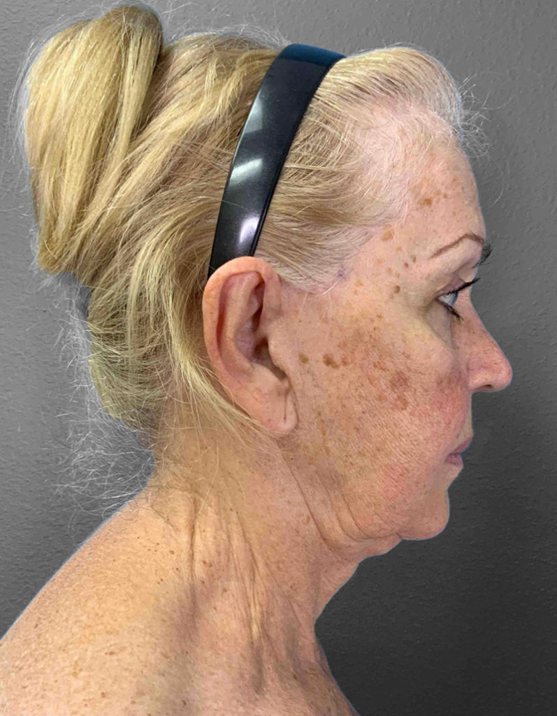 Profile view of a woman highlighting skin texture and neck contour post-surgery.