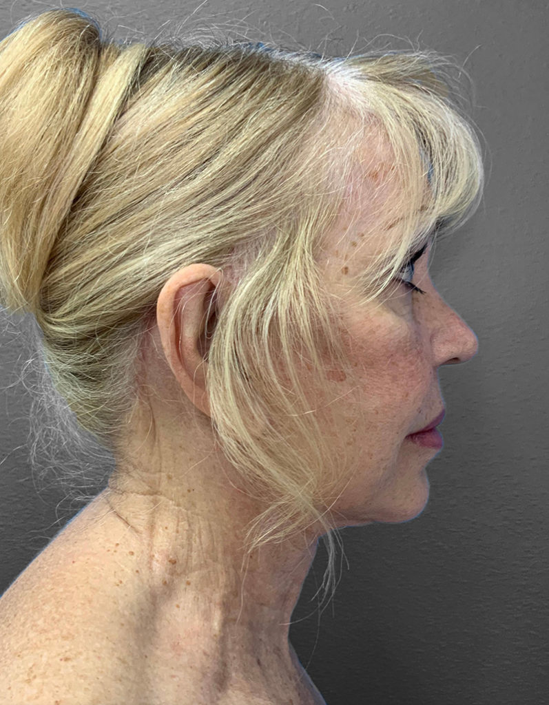 Profile view of a woman showcasing natural results of plastic surgery.