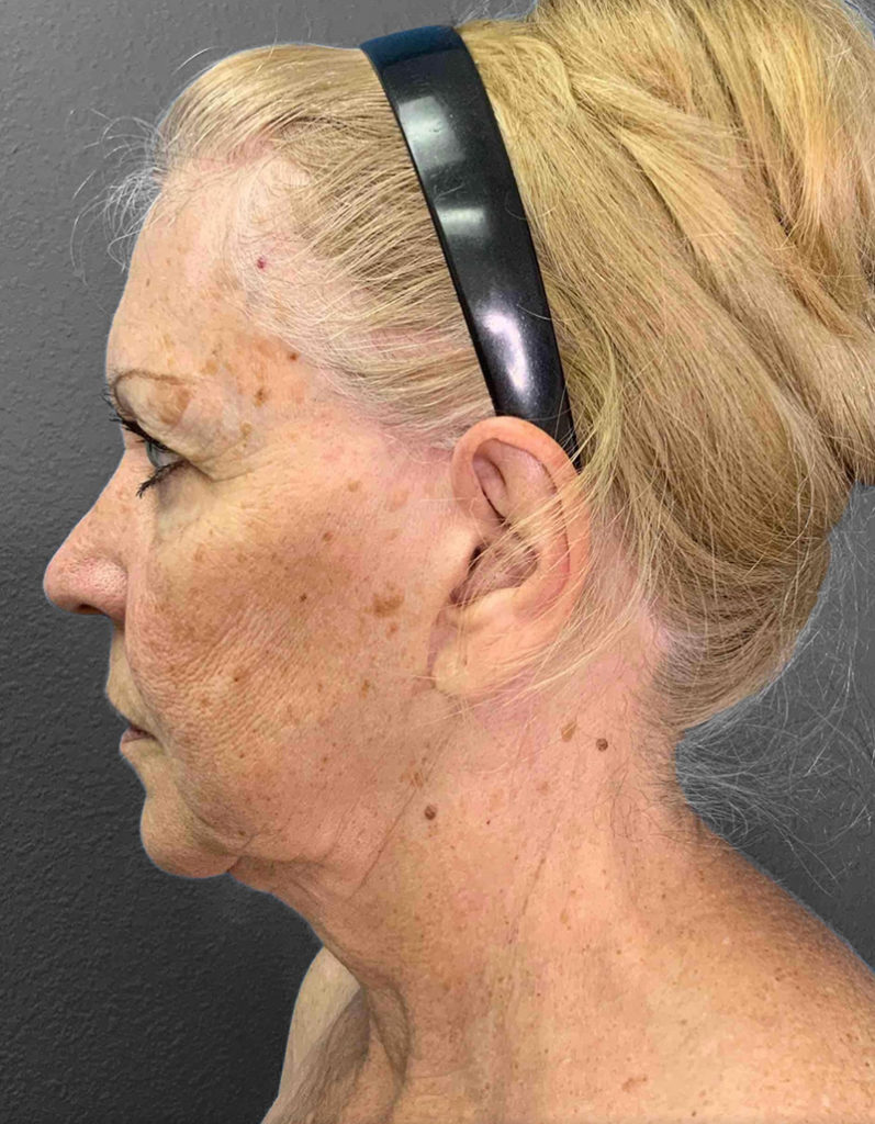 Profile view of mature woman highlighting skin texture and facial contouring.