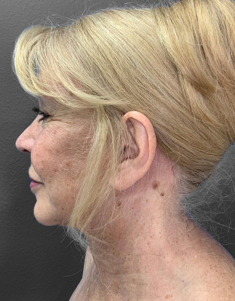 Profile view of a woman highlighting natural beauty post-surgery.