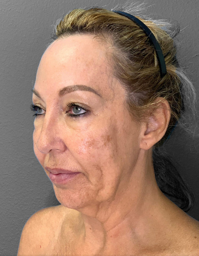 Patient consultation showcasing natural results in facial rejuvenation.