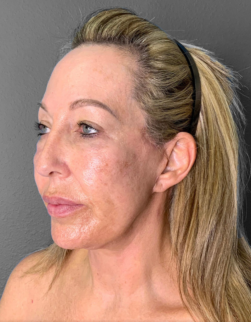 Patient profile showcasing natural results of Lentz Plastic Surgery procedures.