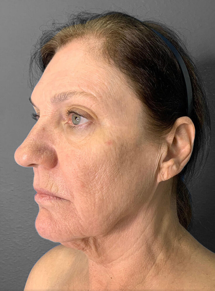 Profile view of a woman showcasing natural skin texture and subtle aging signs.