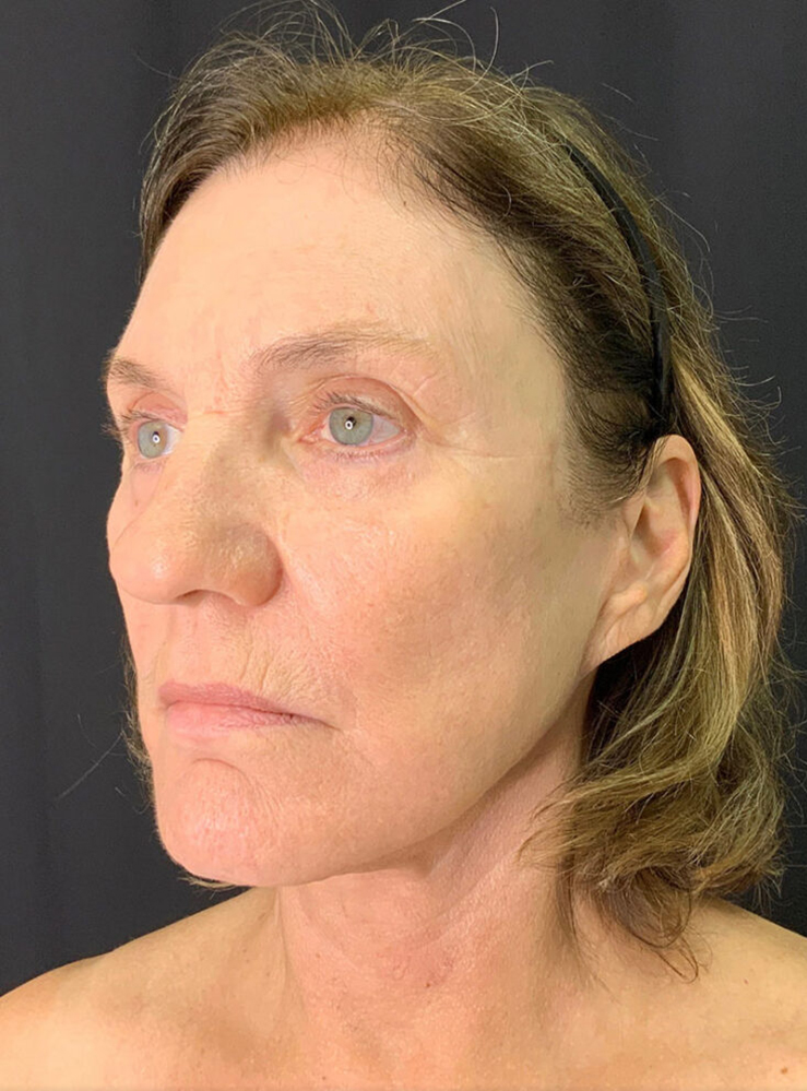 Before treatment consultation, showcasing natural skin texture and facial contours.