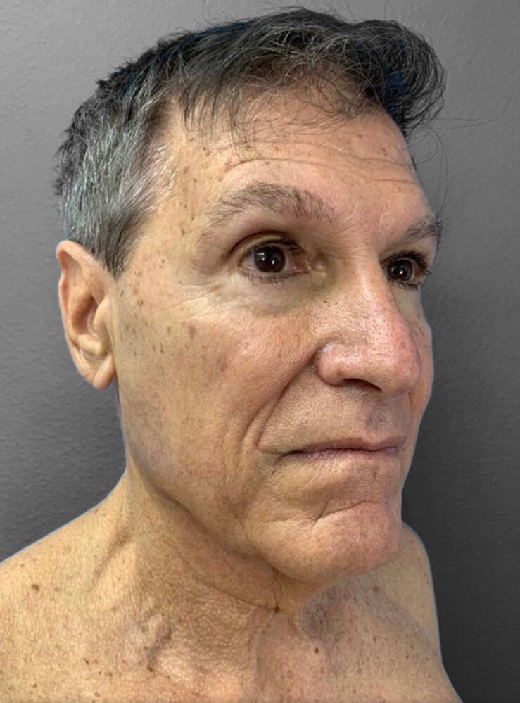 Male patient with natural facial features, showcasing Lentz Plastic Surgery results.