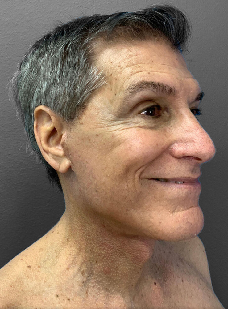 Male patient showcasing natural results from Lentz Plastic Surgery.