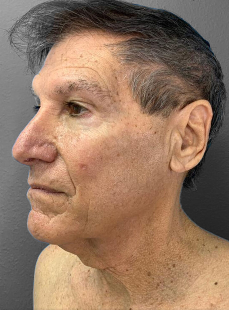 Male patient profile showcasing natural facial contours post-surgery.