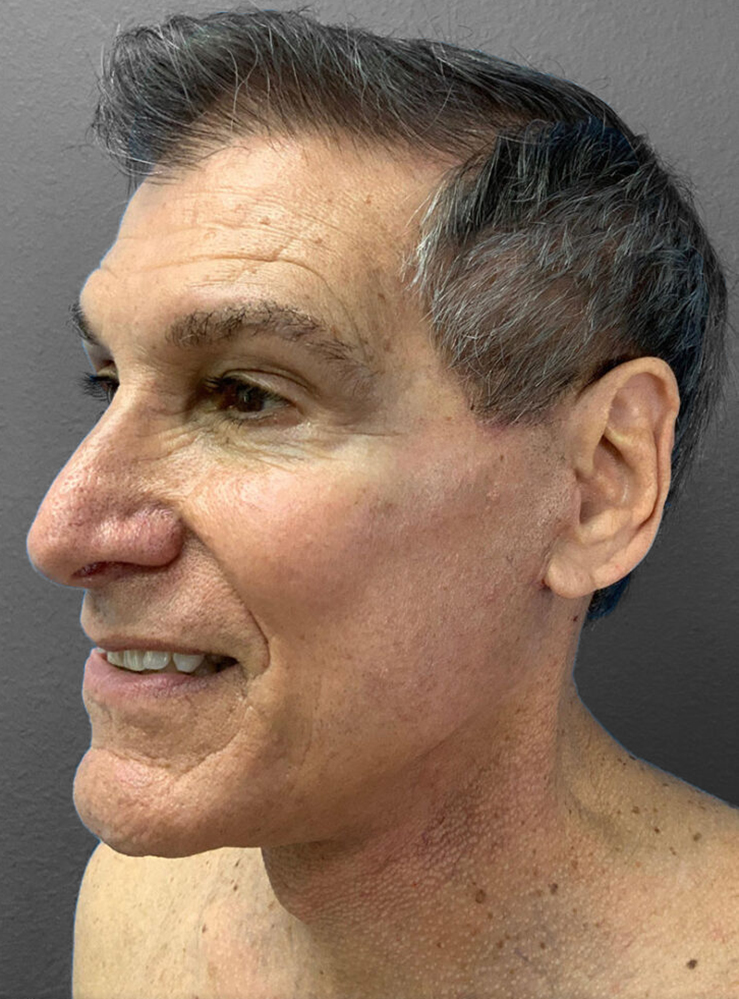 Male patient profile showcasing natural results of facial rejuvenation.