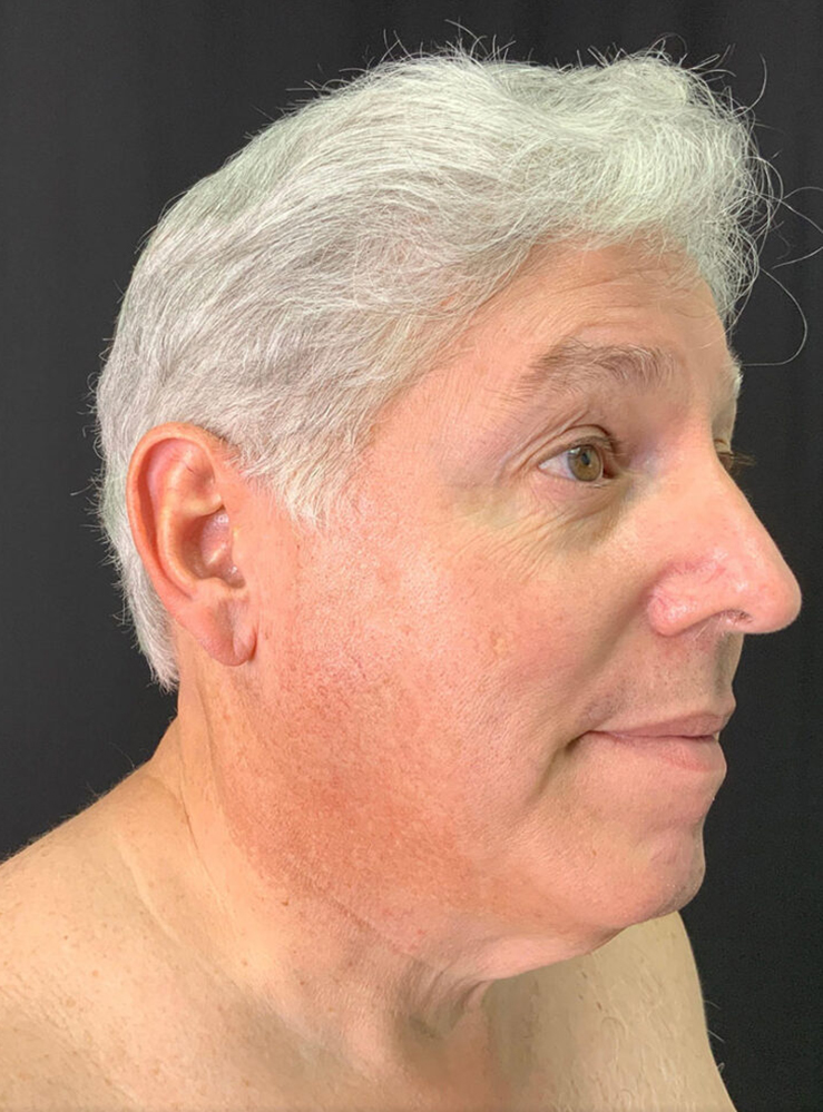 Male patient profile with natural-looking facial enhancement results.