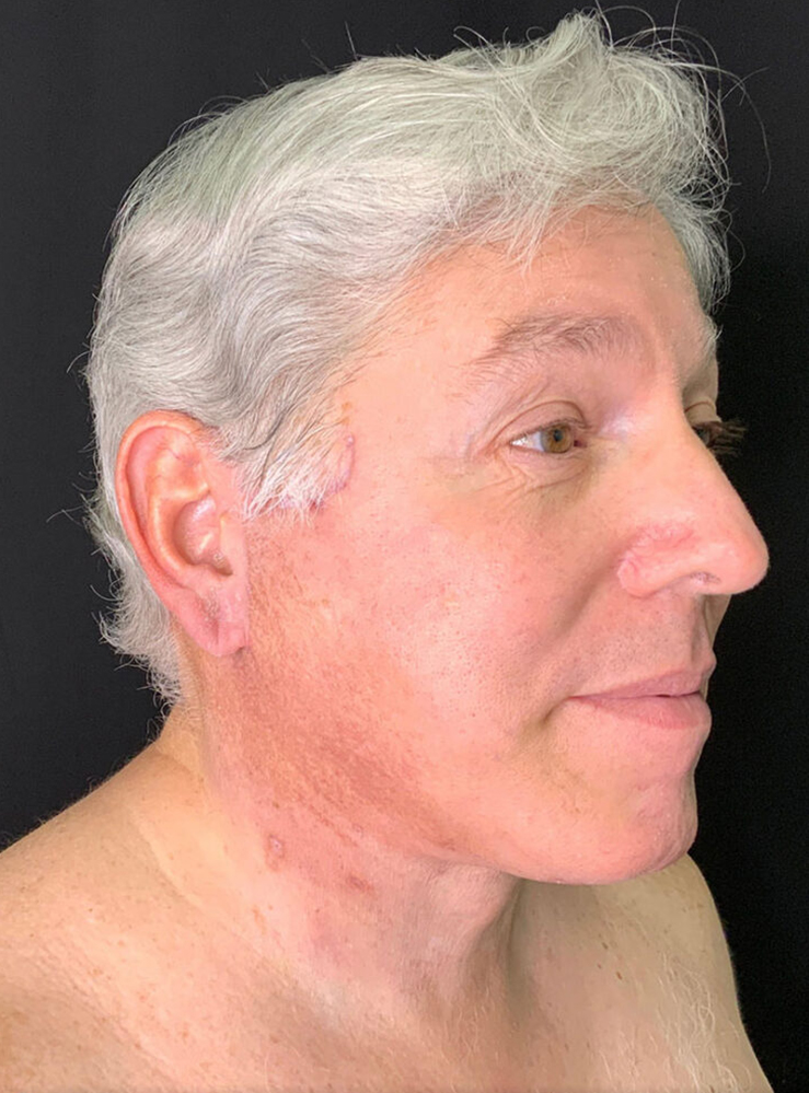 Male patient profile showcasing natural results of cosmetic procedure.