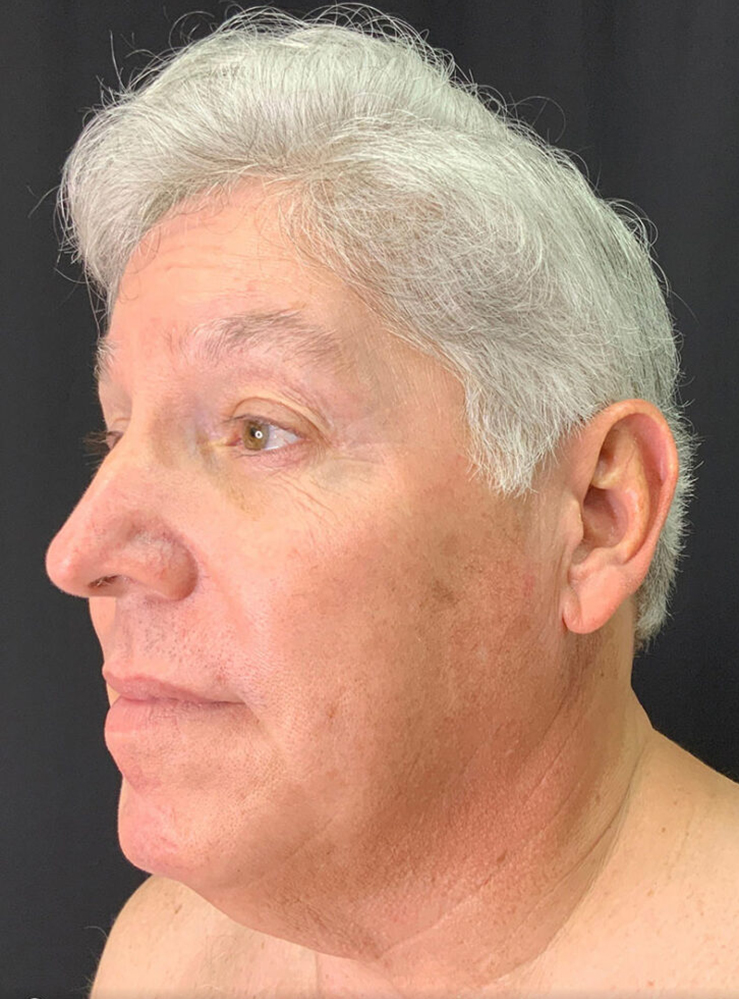Male patient profile, showcasing natural results of facial rejuvenation.