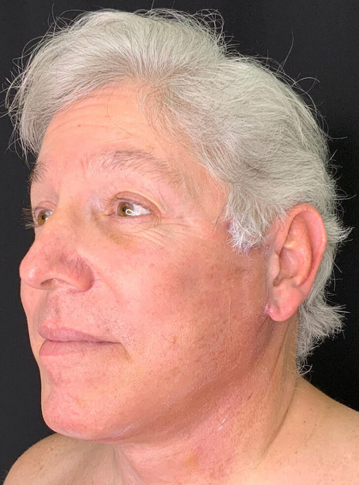 Male patient showcasing post-surgery results at Lentz Plastic Surgery.