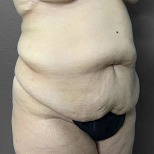 Before and after body contouring results at Lentz Plastic Surgery.