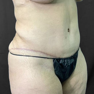 Post-surgery abdomen with visible scarring, showcasing Lentz Plastic Surgery results.