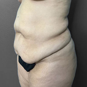 Before and after body contouring results at Lentz Plastic Surgery.