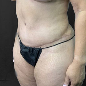 Patient showcasing results after body contouring procedure at Lentz Plastic Surgery.