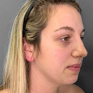 Profile view of a woman showcasing natural facial aesthetics after surgery.
