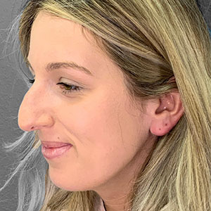 Profile view of a patient post-nose surgery at Lentz Plastic Surgery.