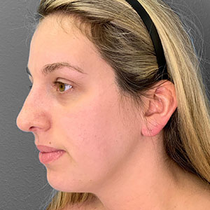 Profile view of a patient showcasing natural results from Lentz Plastic Surgery.