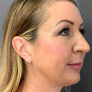Profile view of a woman highlighting natural beauty post-surgery. Lentz Plastic Surgery.