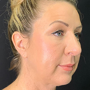 Profile view of a woman showcasing natural skin enhancement results.