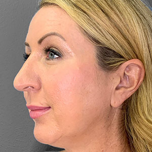 Profile view of a woman showcasing refined facial features post-surgery.