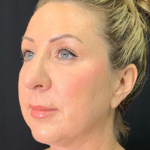 Patient profile showcasing natural results from Lentz Plastic Surgery.