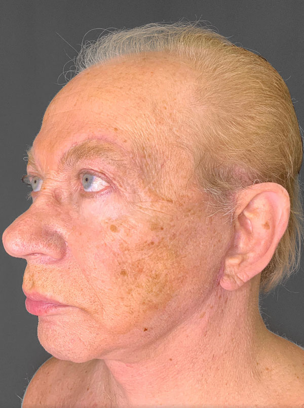 Profile view of a patient post-brow lift, showcasing natural results.