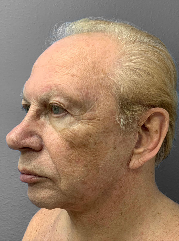 Profile view of a mature male patient post-brow lift at Lentz Plastic Surgery.