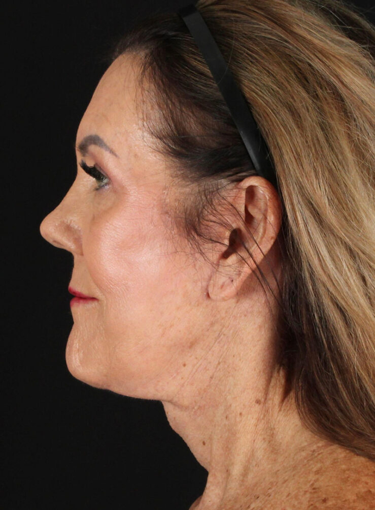 Profile view of a mature woman highlighting facial contours and skin texture.