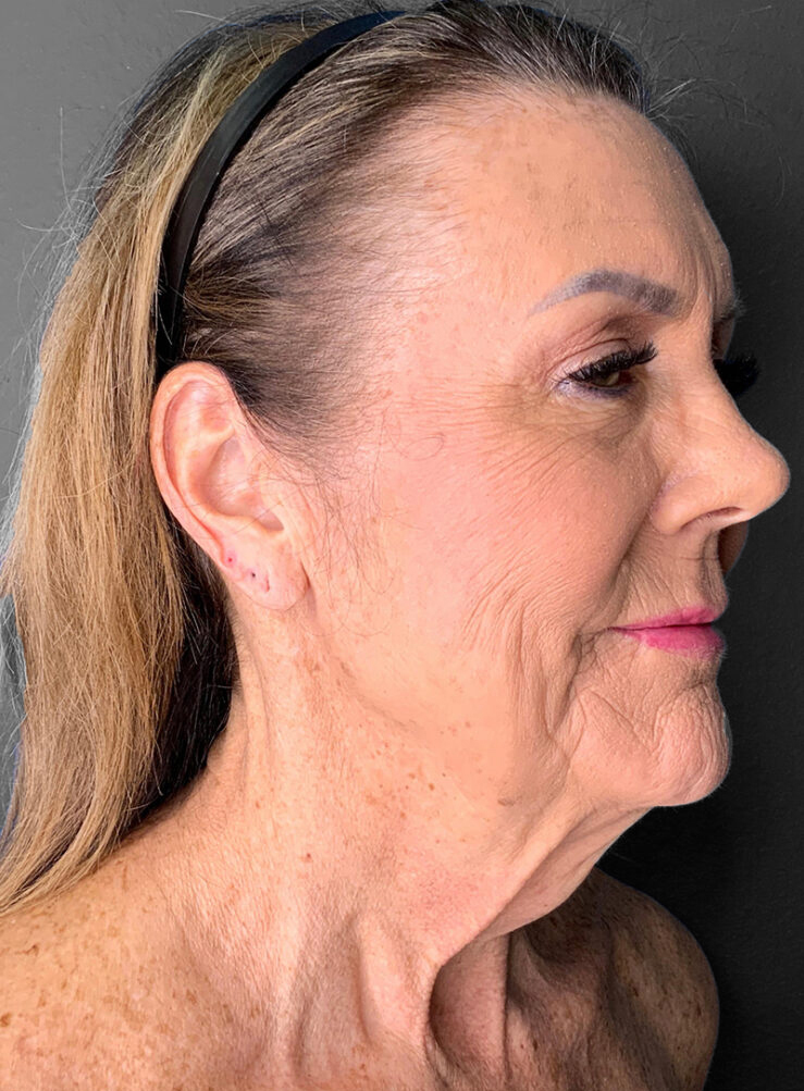Profile view of a mature woman showcasing natural skin texture and subtle cosmetic enhancements.
