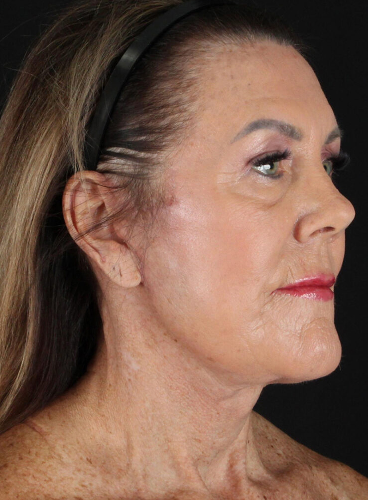 Side profile of a mature woman highlighting natural beauty and skin rejuvenation.