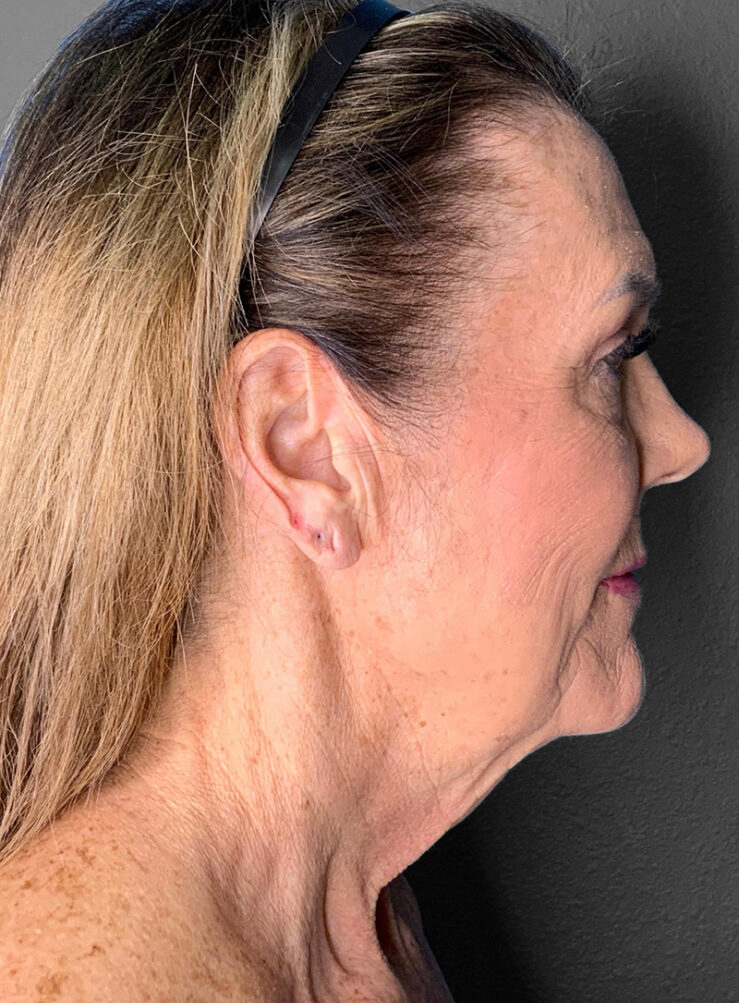 Profile view of a mature woman highlighting skin texture and facial contours.