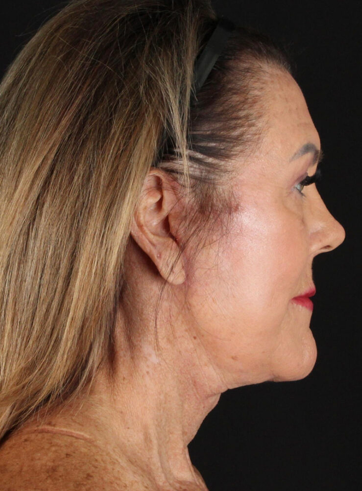 Profile view of a woman highlighting facial rejuvenation results.